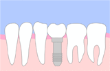 インプラント