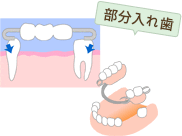 部分入れ歯