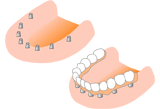 インプラント